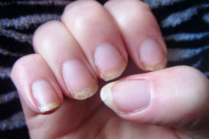 Important! 8 Things Your Nails Say About Your Health